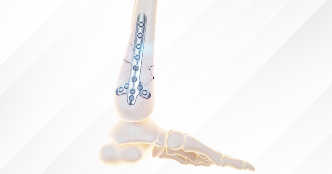 From Fracture to Fixation: How Trauma Implants Help Bones Heal?