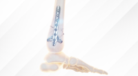 From Fracture to Fixation: How Trauma Implants Help Bones Heal?