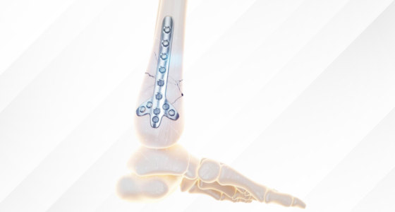 From Fracture to Fixation: How Trauma Implants Help Bones Heal?