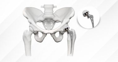 Myths About Metal Implants