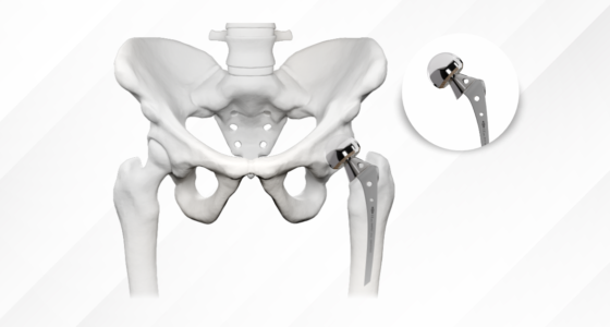 Myths About Metal Implants