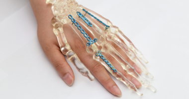 When Are Orthopedic Implants Removed? Understanding Temporary vs. Permanent Fixation