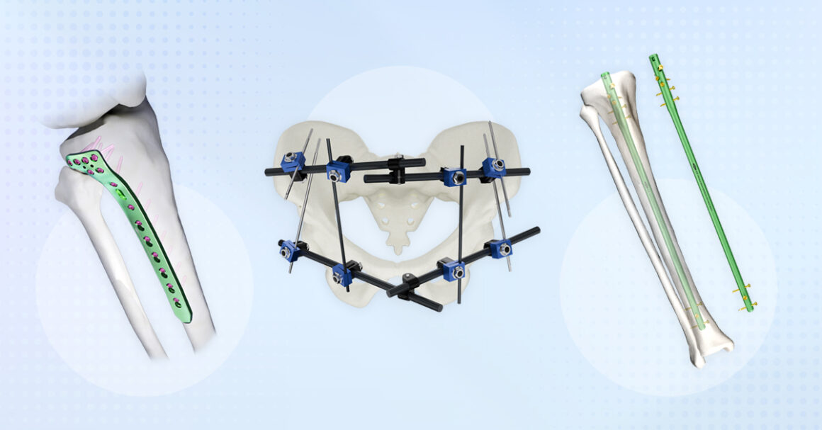 Best Practices for Choosing the Right Implant for Trauma Cases