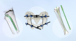 Best Practices for Choosing the Right Implant for Trauma Cases
