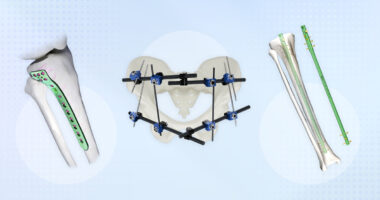 Best Practices for Choosing the Right Implant for Trauma Cases