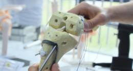 Aperture Fixation in Anterior Cruciate Ligament Reconstruction