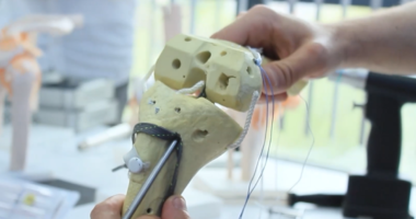 Aperture Fixation in Anterior Cruciate Ligament Reconstruction