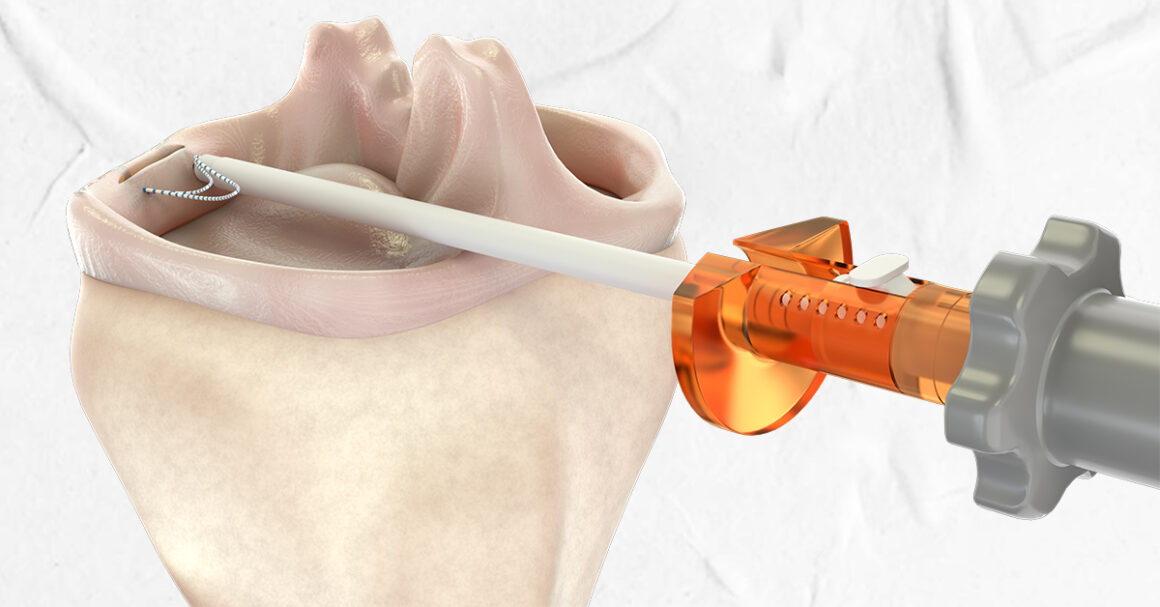 Meniscal Root Tears
