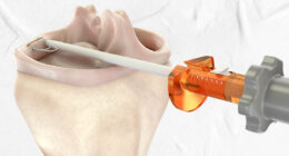 Meniscal Root Tears