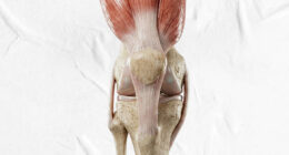 QUADRICEPS TENDON AUTOGRAFT