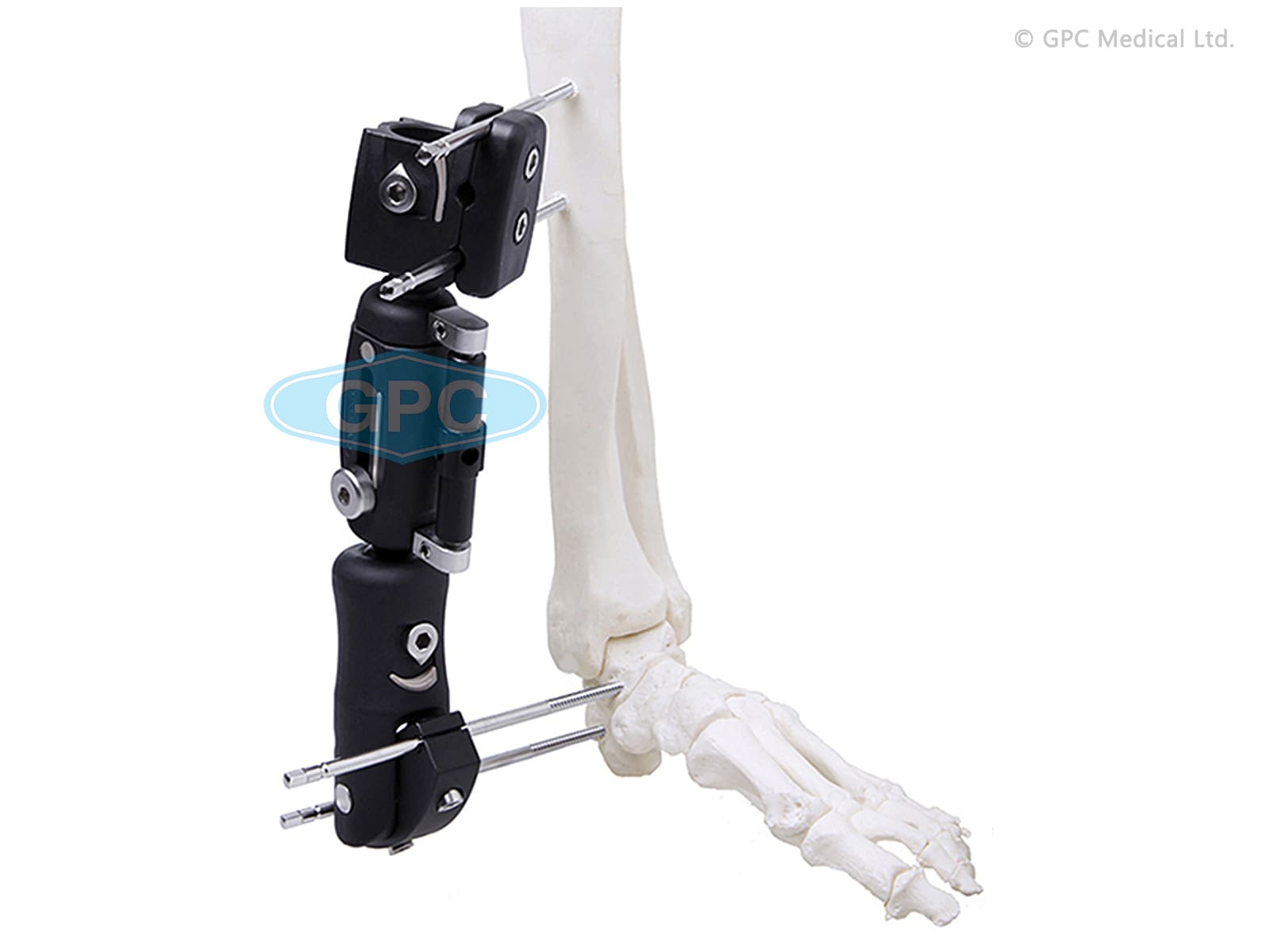 Ankle Joint External Fixator in PEEK