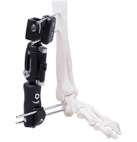 Ankle Joint External Fixator in PEEK